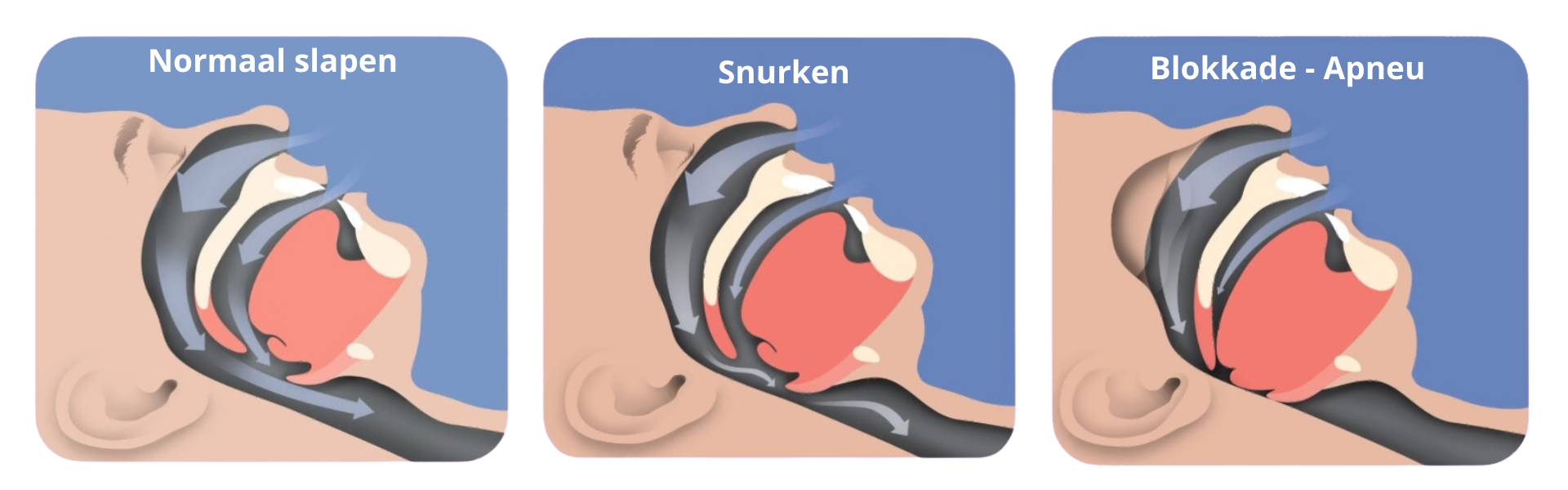 Snurkportaal wat is snurken